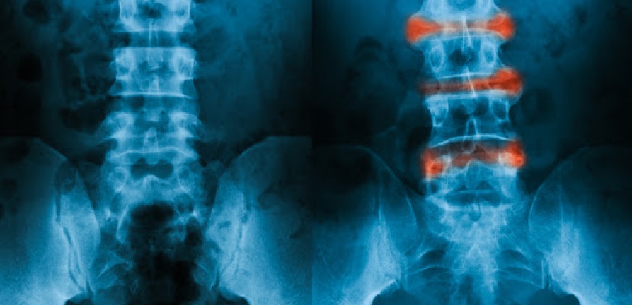 Dores na lombar e nas pernas podem ser sinais da Espondilite Anquilosante